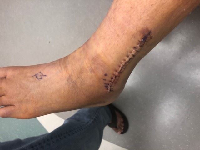 Left foot of injured client with stitches along the outer ankle